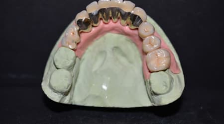 Dental Team - Studio Odontotecnico a Firenze - protesi combinata su conometria