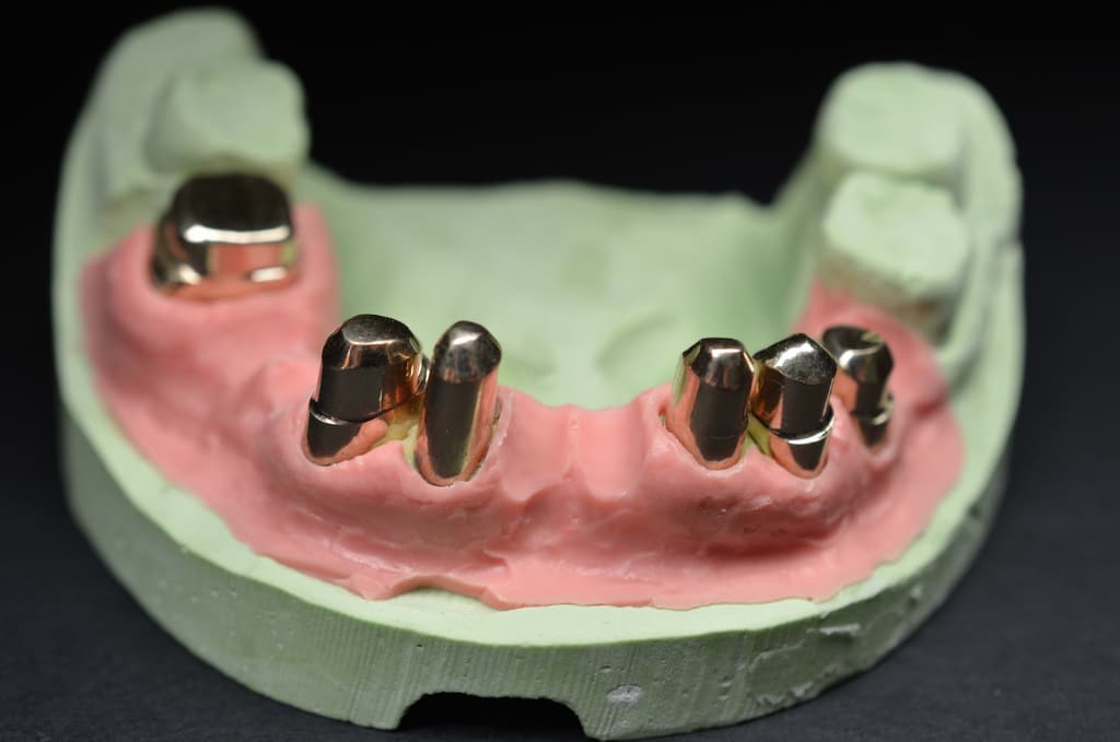 Dental Team - Studio Odontotecnico a Firenze - protesi combinata su conometria