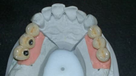 Dental Team - Studio Odontotecnico a Firenze - protesi fissa in metallo ceramica
