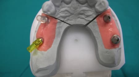 Dental Team - Studio Odontotecnico a Firenze - protesi fissa in metallo ceramica