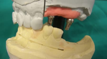 Dental Team - Studio Odontotecnico a Firenze - protesi fissa in metallo ceramica