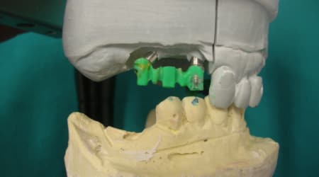 Dental Team - Studio Odontotecnico a Firenze - protesi fissa in metallo ceramica