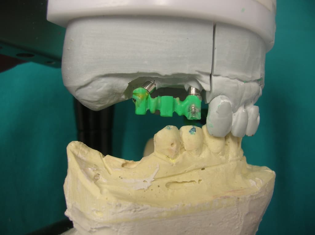 Dental Team - Studio Odontotecnico a Firenze - protesi fissa in metallo ceramica