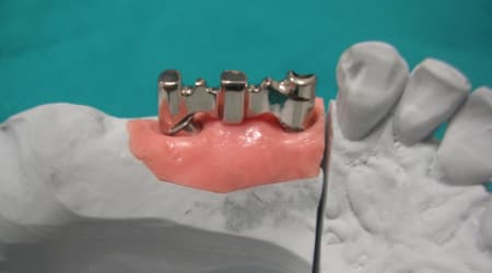 Dental Team - Studio Odontotecnico a Firenze - protesi fissa in metallo ceramica