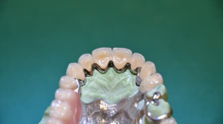 Dental Team - Studio Odontotecnico a Firenze - protesi combinata fresaggi