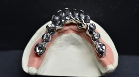 Dental Team - Studio Odontotecnico a Firenze - protesi fissa Toronto bridge