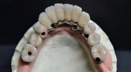 Dental Team - Studio Odontotecnico a Firenze - protesi fissa Toronto bridge